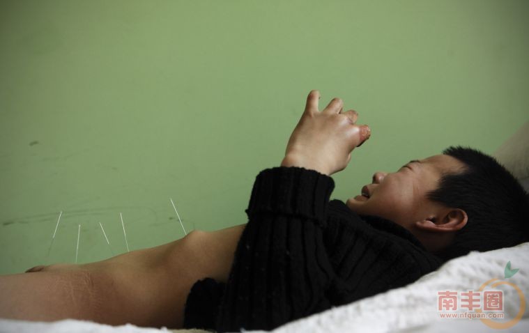 11 秦春浩,糖丸受害者，下肢瘫痪，现每周两次针灸防止肌肉萎缩.jpg